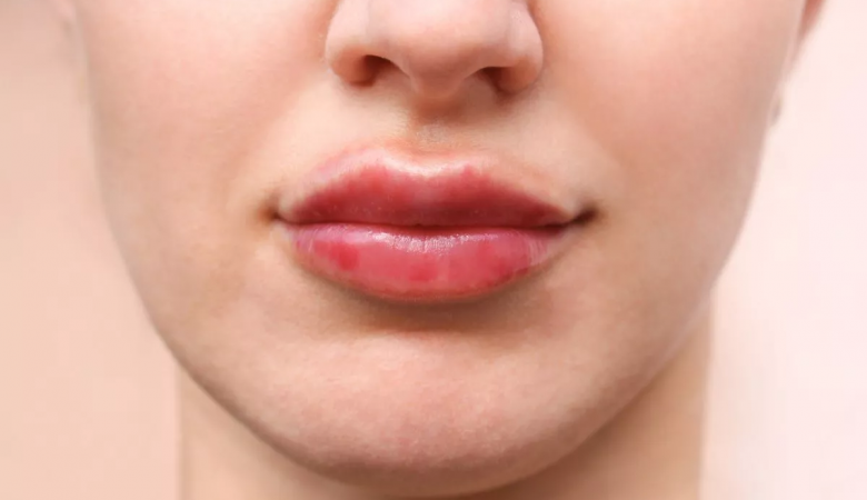 Гіалуронові вуса: що це таке і чому після збільшення губ виникає цей ефект?
