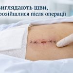 Як зрозуміти, що розійшлися шви після операції: симптоми, причини та коли терміново до лікаря