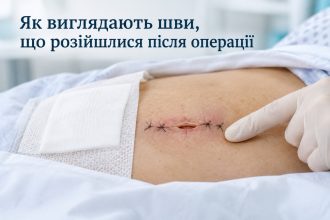 Як зрозуміти, що розійшлися шви після операції: симптоми, причини та коли терміново до лікаря